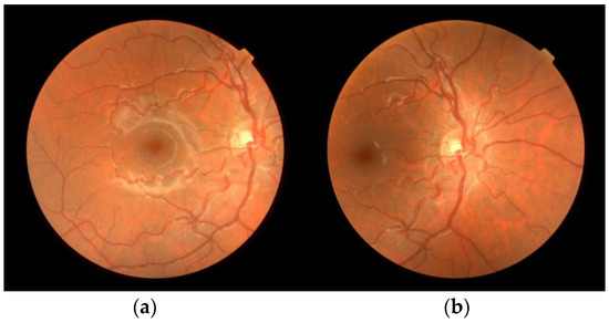 Retina AI Diagnosis